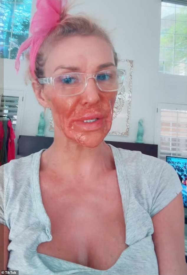 Brandi Glanville says she burned her face after trying hair removal cream as a DIY treatment.