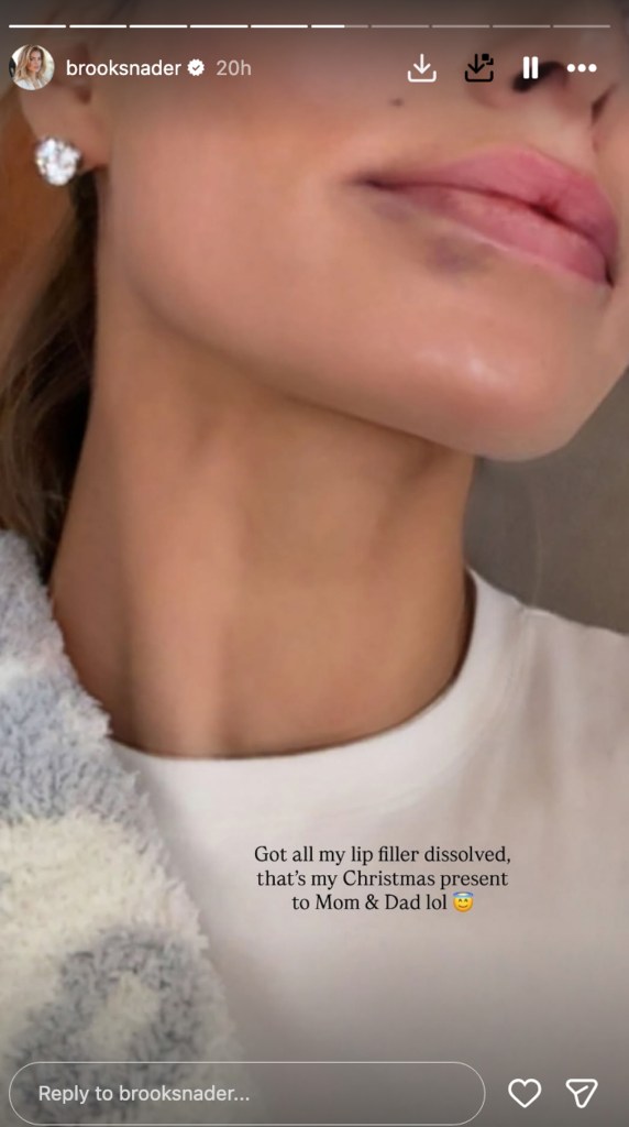 Close-up selfie of Brooks Nader's lips after dissolving filler, shared on Instagram Stories.