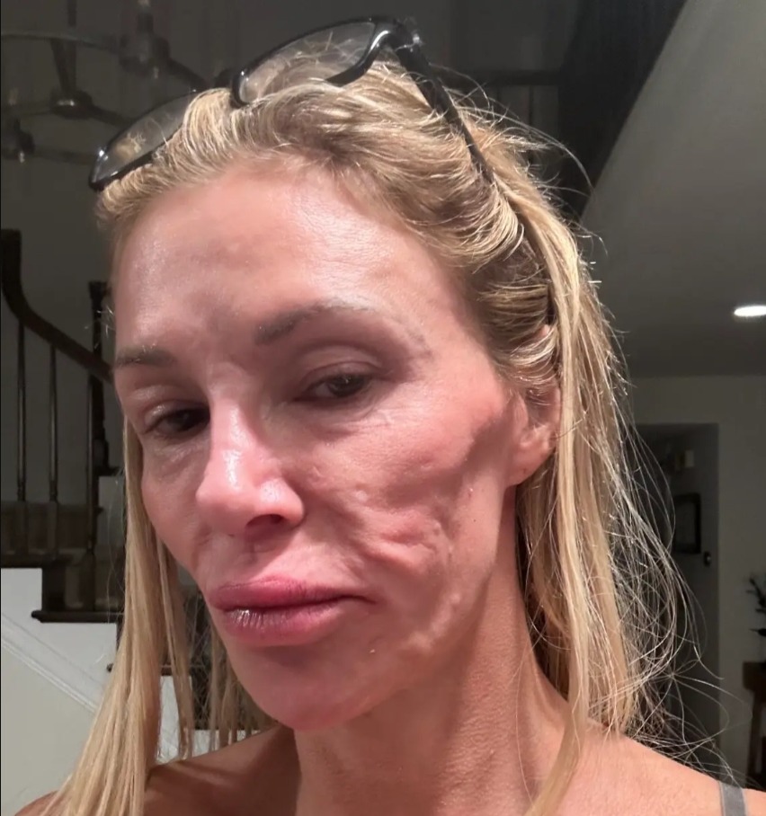 Brandi Glanville in an earlier photo with visible facial swelling and redness amid her years-long health struggle.