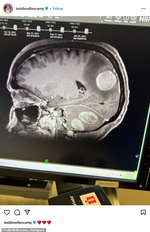 Teddi Mellencamp underwent surgeries to remove brain tumors and received radiation and immunotherapy treatments